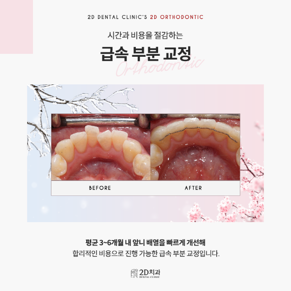"아무도 모르게 예뻐지자" 티 안나는 <2D교정> 관련 이미지 4