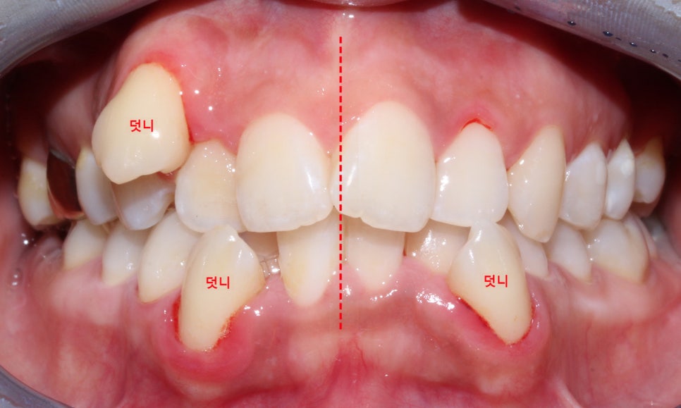 crowding 송곳니덧니 세라믹교정 방법 관련 이미지 1