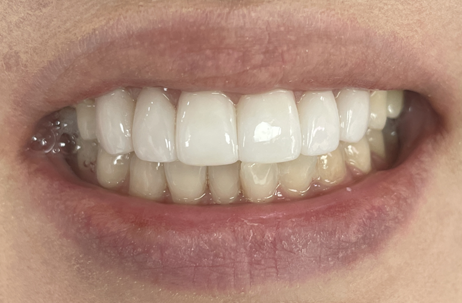 옥니 라미네이트 치아고민은 그만 치아삭제 없는 블랙필름으로 해결 관련 이미지 5