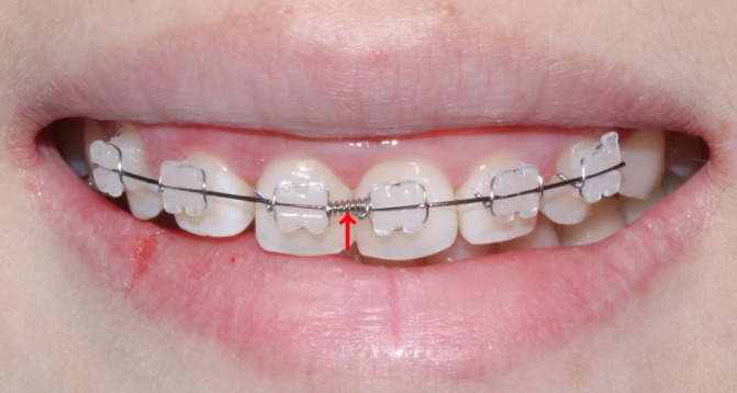 옥니 라미네이트 치아고민은 그만 치아삭제 없는 블랙필름으로 해결 관련 이미지 4