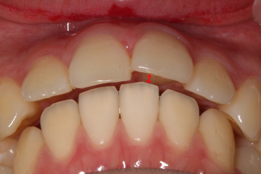 입돌출 데이몬교정 Case1 관련 이미지 2