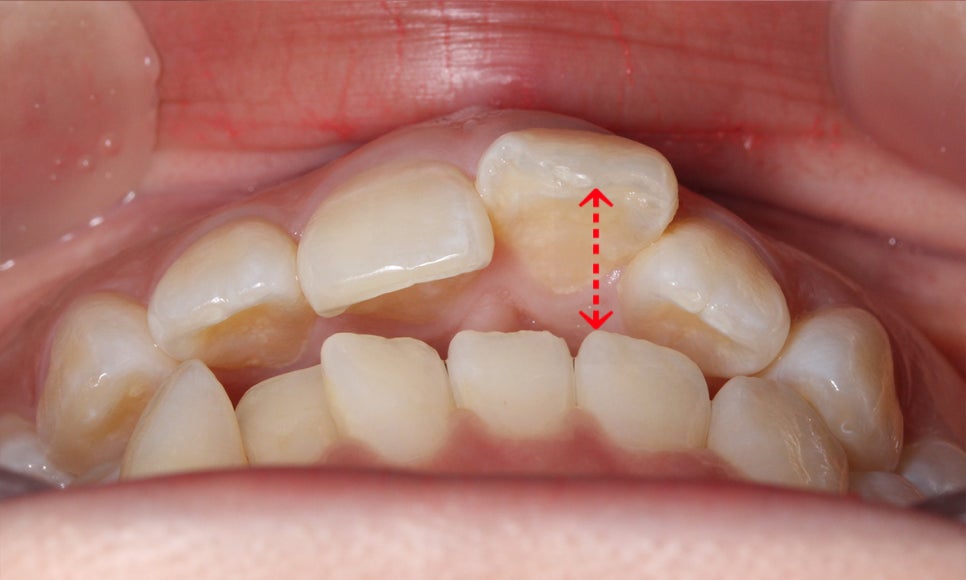 앞니돌출 급속교정 Case feat. 2D교정 관련 이미지 3