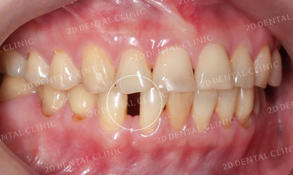누렇고 손상된 치아를 밝고 가지런하게! by. 투디치과(2D치과)_블링스 시술후기 관련 이미지 7