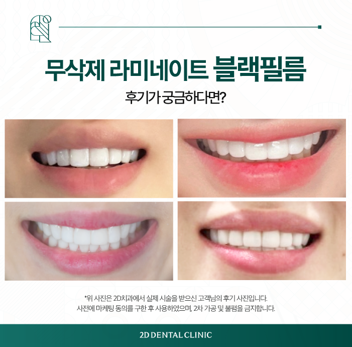 무삭제라미네이트 내 치아에 손상 없이! 관련 이미지 7