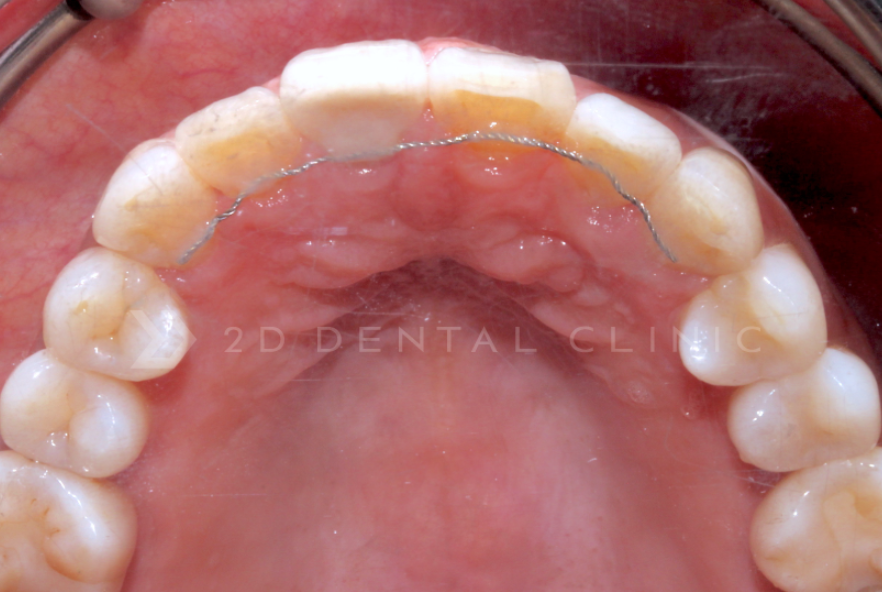 앞니 무삭제라미네이트 고객맞춤형 치아제작하는 블랙필름 관련 이미지 3