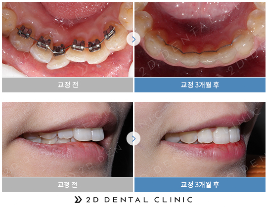 2D Plus+(플러스) 교정, 심한 케이스도 티 나지 않게! 관련 이미지 7