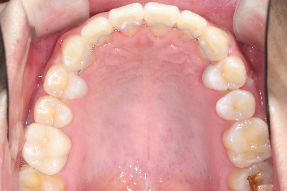 논현동치과 윗니부분교정 후기 관련 이미지 12