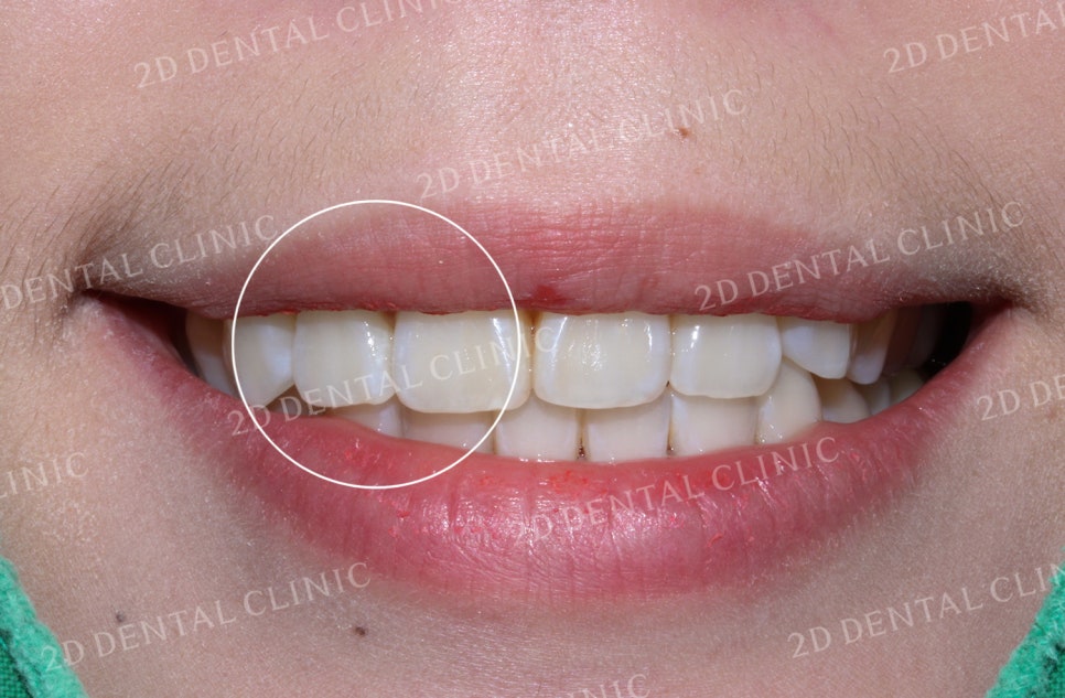 돌출입, 돌출앞니를 부분교정으로 고르게! by.투디치과(2D치과) 관련 이미지 9