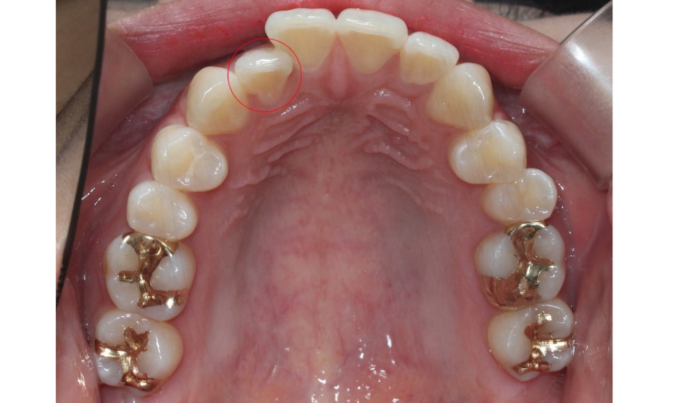 신논현치과 자가결찰브라켓 장점 관련 이미지 7