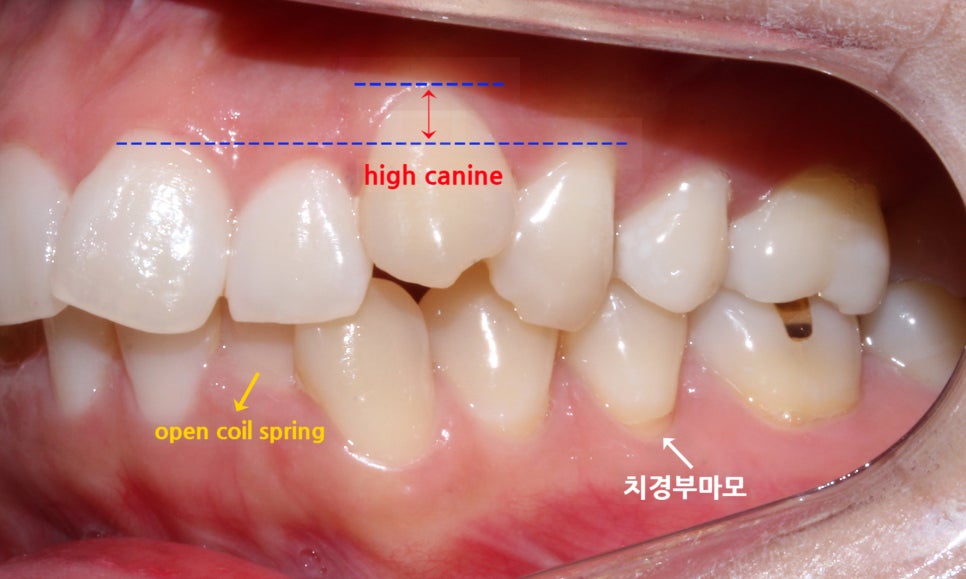 역삼역치과 송곳니덧니 crowding Case 관련 이미지 5