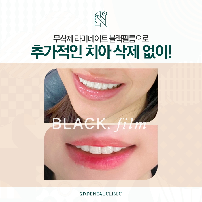 무삭제라미네이트비용 블랙필름 왜소치 고민 해결! 관련 이미지 6