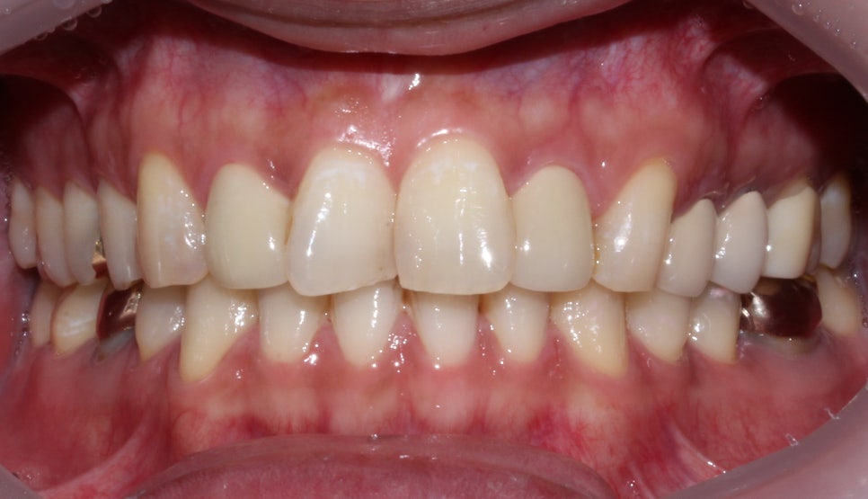 라미네이트에서 중요한 것은..심미적 요소, 블링스 관련 이미지 5