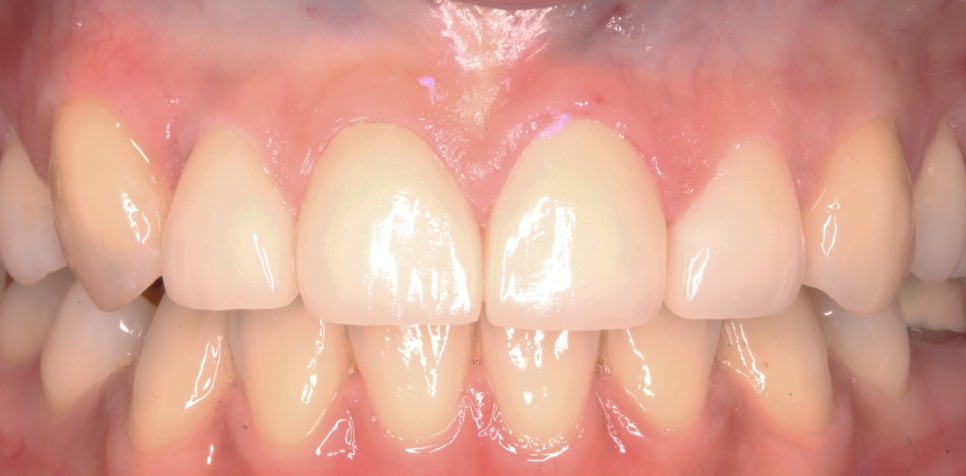 교정일기:앞니 부분 블링스(라미네이트) 심리보철 진료과정 후기 관련 이미지 5