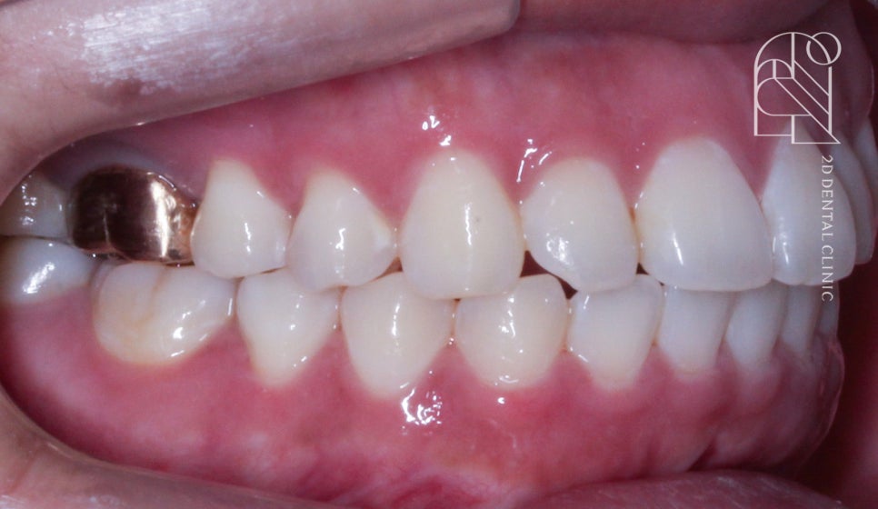 부정교합 치아교정, 전체교정으로 완성하기! by. 투디치과(2D치과) 관련 이미지 12