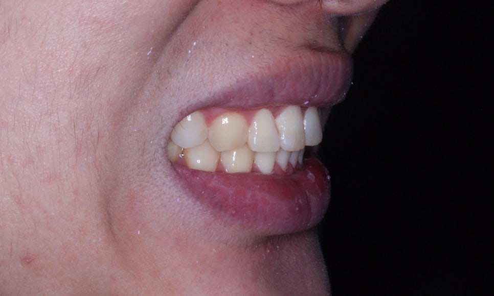 나비치아교정! 15개월만에 빠른 교정 by.투디치과(2D치과) 관련 이미지 9