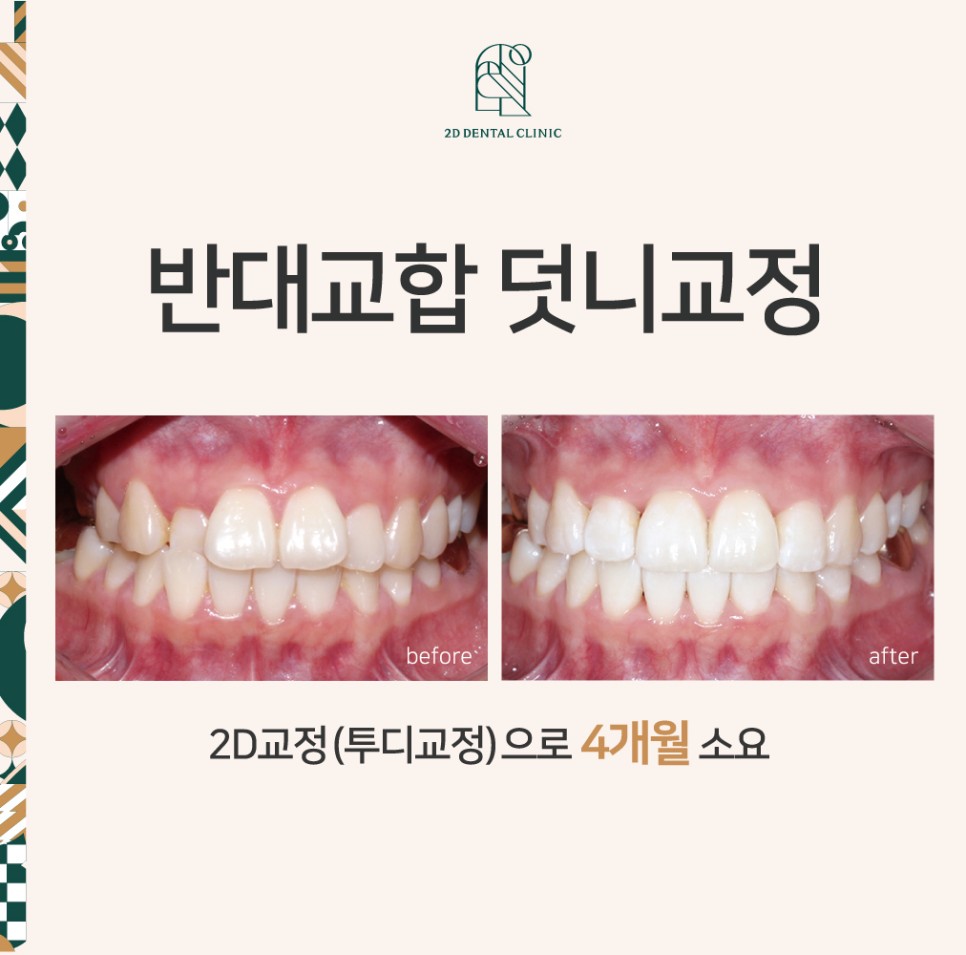 2D치과 2D교정으로 4개월만에 덧니 개선! 관련 이미지 1