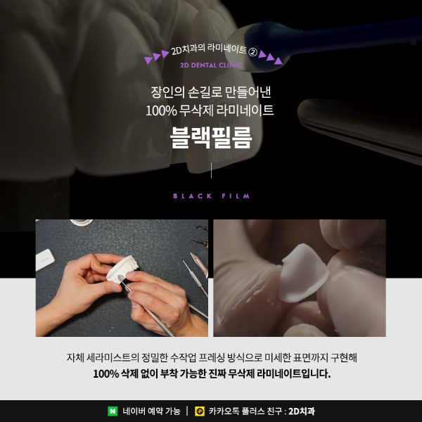 "다시 복구 못해요" 앞니라미네이트 치아 삭제량이 중요한 이유 관련 이미지 6