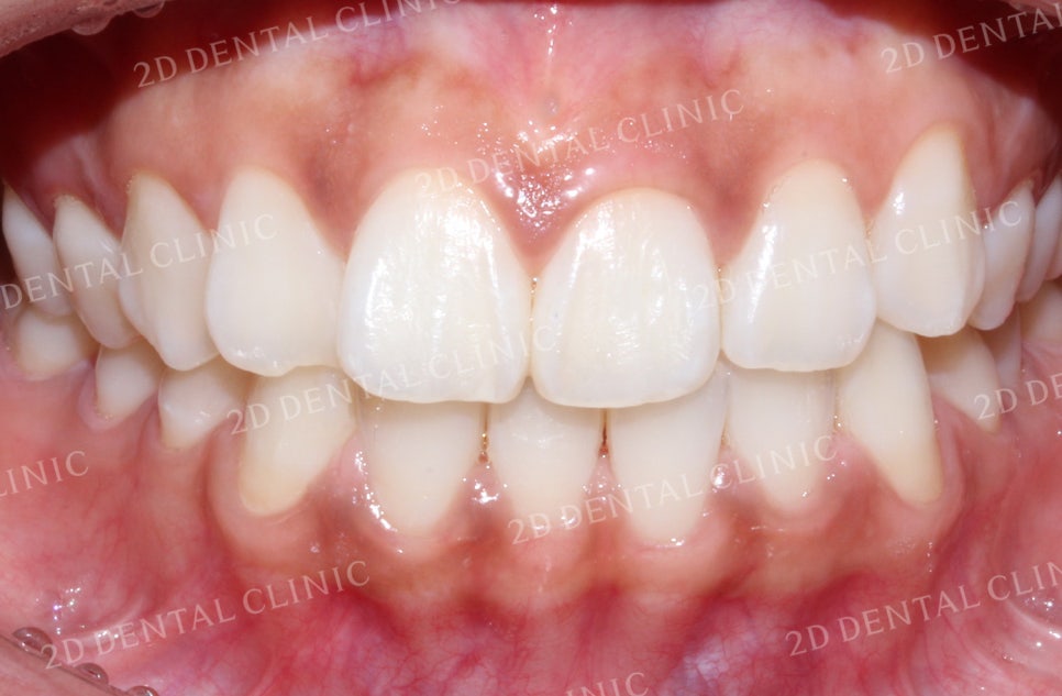 돌출입, 돌출앞니를 부분교정으로 고르게! by.투디치과(2D치과) 관련 이미지 10
