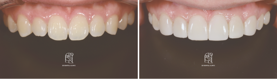 강남라미네이트치과 추천 : 진짜 무삭제, 투디치과! 관련 이미지 13