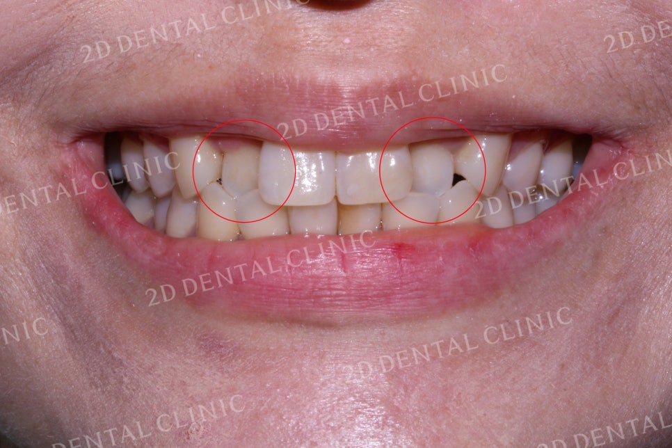 반대교합으로 물리는 치아를 바른 교합으로 교정하기! by.투디치과(2D치과) 관련 이미지 2