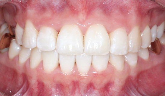 덧니치아 2D교정으로 4개월만에 교정 끝! by.투디치과(2D치과) 관련 이미지 17