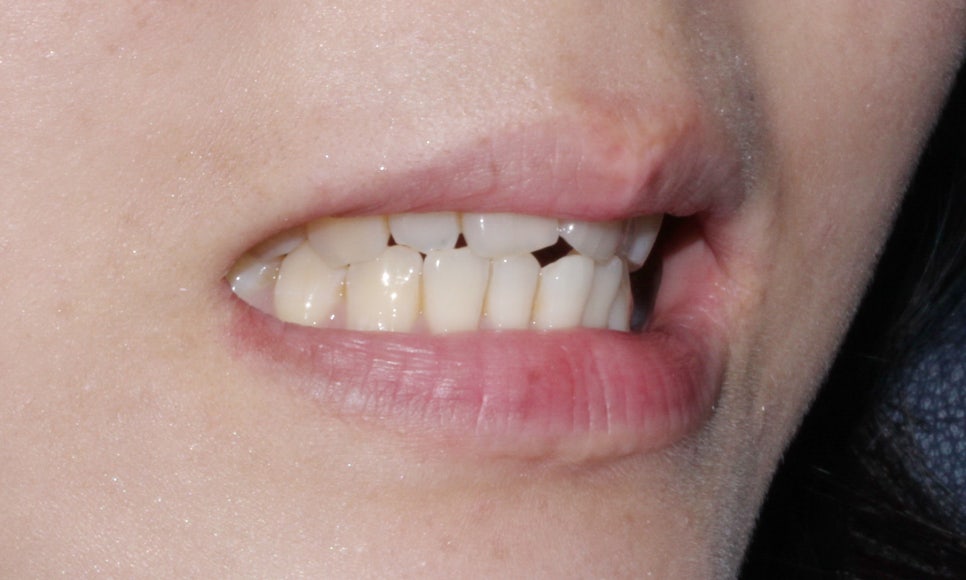 안 보이는 교정!2D교정 잘하는 강남 신논현 근처 2D치과! 관련 이미지 2