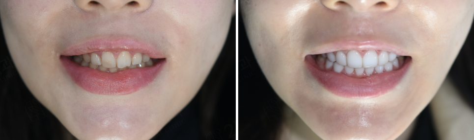 강남라미네이트치과 추천 : 진짜 무삭제, 투디치과! 관련 이미지 8