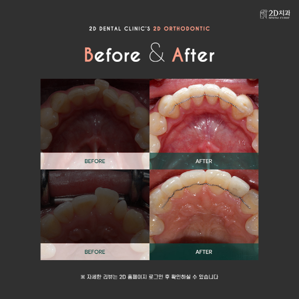 쉿! 아무도 몰라, 티 안 나는 교정 비결 <2D교정> 관련 이미지 6
