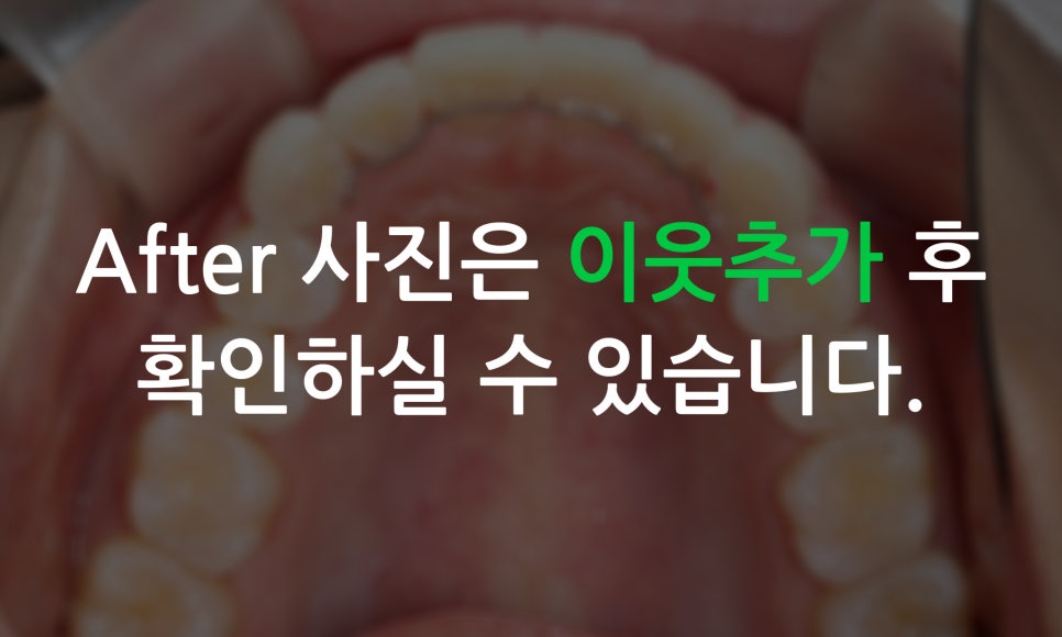 송곳니덧니 교정과 왜소치 세라필름을 한번에! 관련 이미지 12