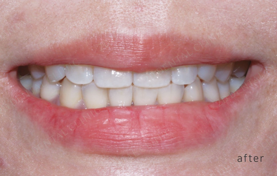 2D치과(투디치과) 교정일기ㅣ앞니덧니,반대교합 치아교정 완료!(ft.투디교정 전체교정) 관련 이미지 14