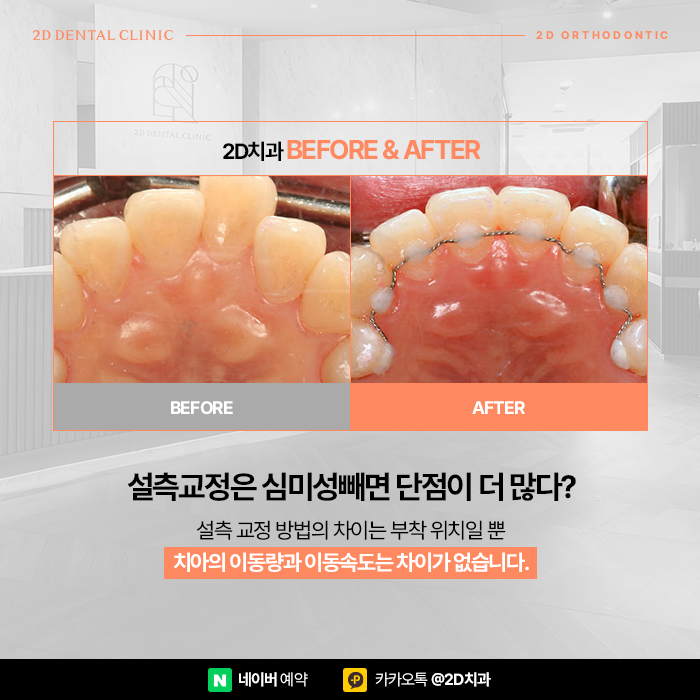 효과적인 설측교정을 위한 정보, 신논현 교정전문의치과 관련 이미지 6