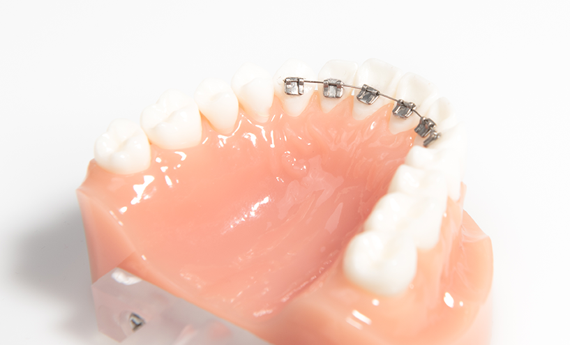 부분교정으로 삐뚤어진 앞니 예뻐지는 방법 관련 이미지 1