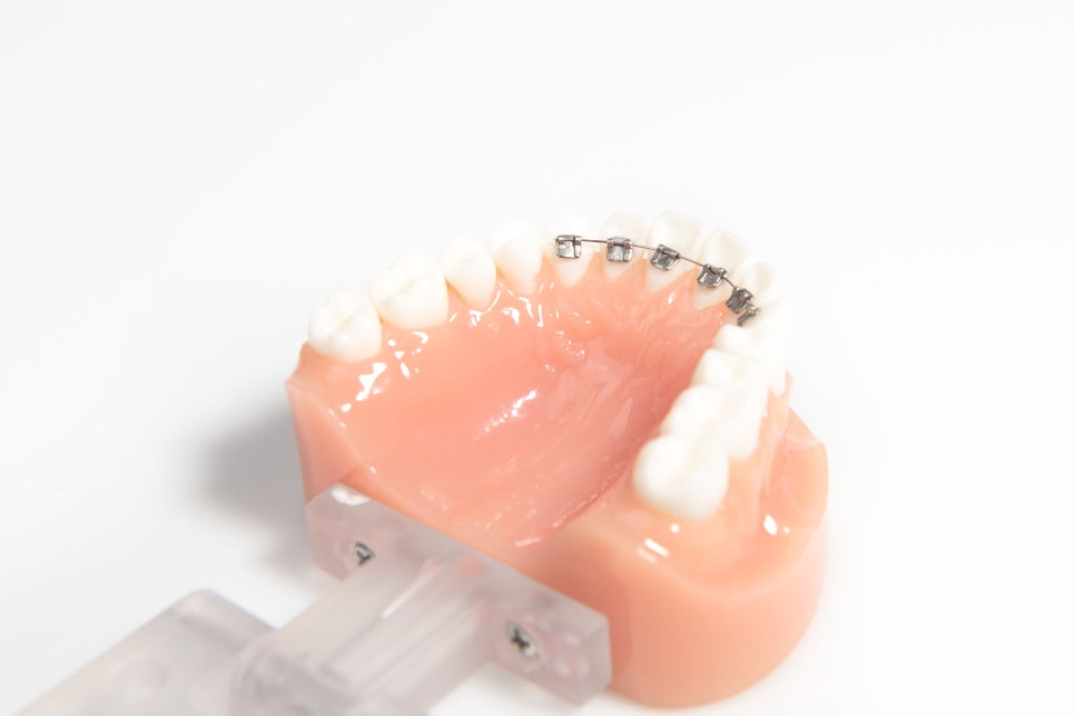 강남역치과[투디치과]투디교정/앞니교정 관련 이미지 5