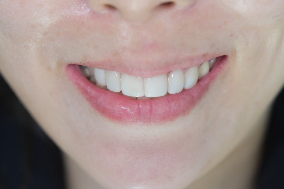 라미네이트치과 알아본다면? 관련 이미지 7