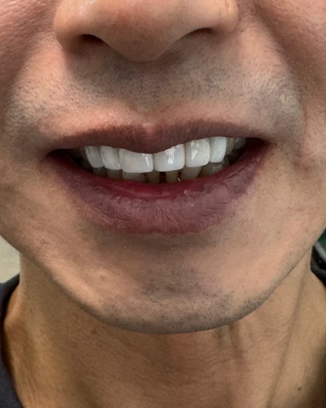 치아 심미치료 개선이 가능한 무삭제 라미네이트 블랙필름 관련 이미지 4