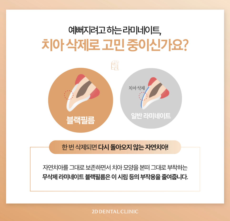 광주무삭제라미네이트 치아미백효과 자연스러움을 찾는 분들 주목 관련 이미지 4
