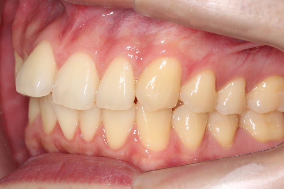 논현동치과 윗니부분교정 후기 관련 이미지 5