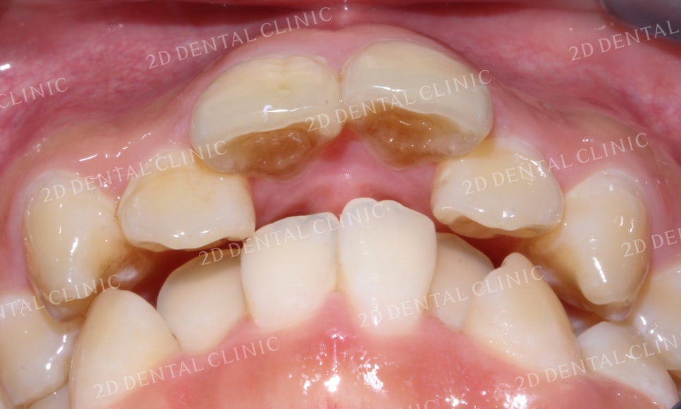 돌출앞니 교정, 튀어나온 입을 넣어보자! by.투디치과(2D치과) 관련 이미지 5