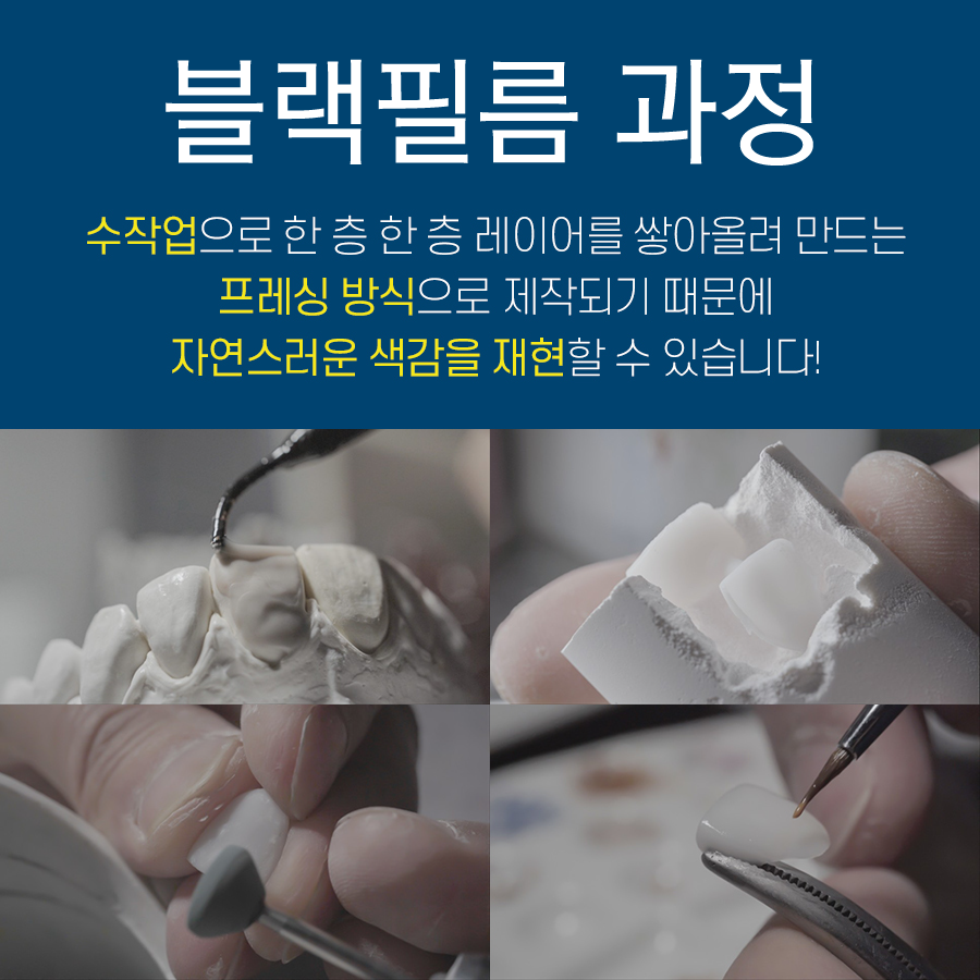 [투디치과] 블랙필름(비스포크) 치료의 다양한 사례 관련 이미지 5
