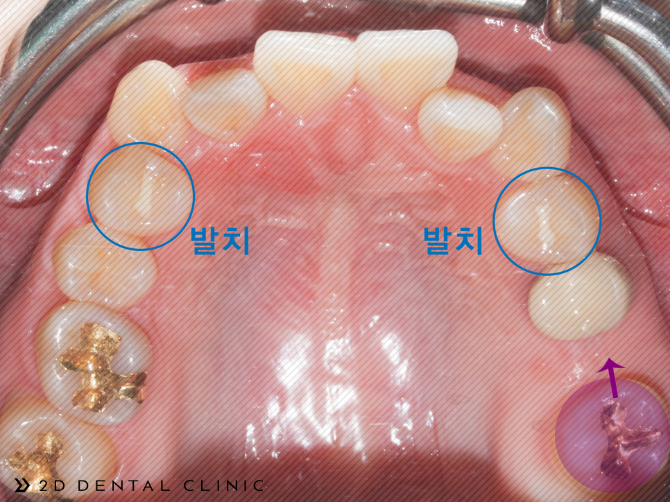 발치교정 돌출입 케이스, 교정전문 2D치과 관련 이미지 6