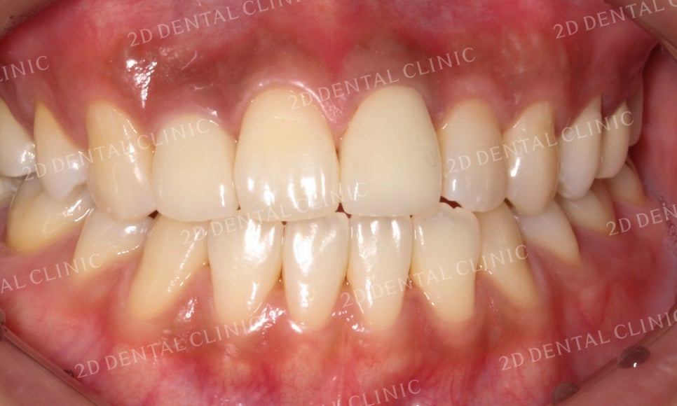 치아변색, 까맣게 변한 변색치를 블링스(Blinx)로 수복하기! by. 투디치과(2D치과) 관련 이미지 9