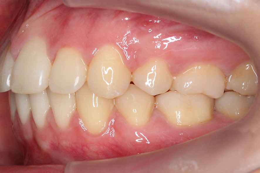 입돌출 데이몬교정 Case1 관련 이미지 13