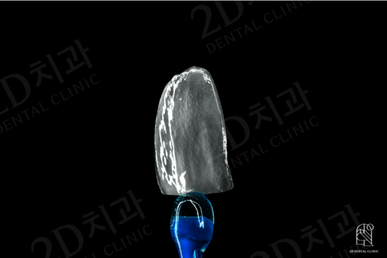 앞니라미네이트 잘하는 곳 : 2D치과 관련 이미지 2