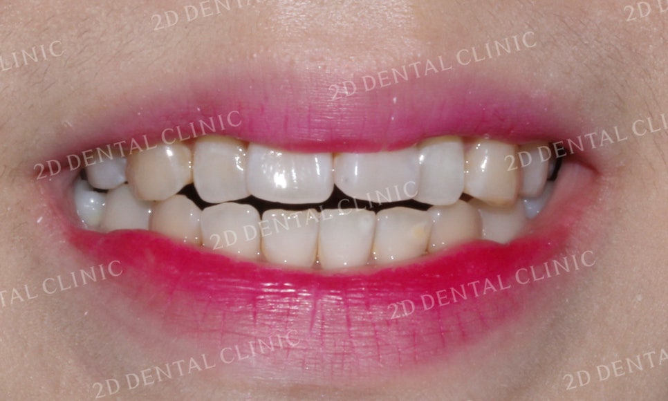 [앞니교정] 부정교합 교정, 앞니교정으로 부정교합 교정하는 방법! by. 투디치과(2D치과) 관련 이미지 9