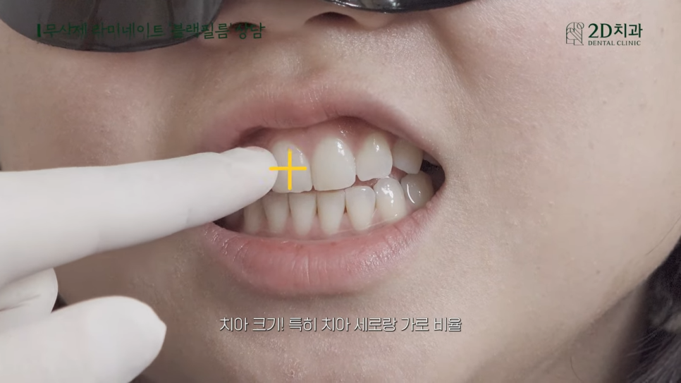 [블랙필름 상담받고 왔어요] #3 앞니가 깨졌어요 관련 이미지 12