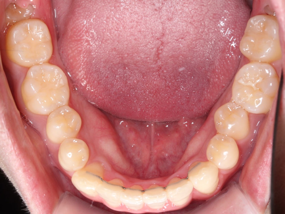 부분교정으로 삐뚤어진 앞니 예뻐지는 방법 관련 이미지 20