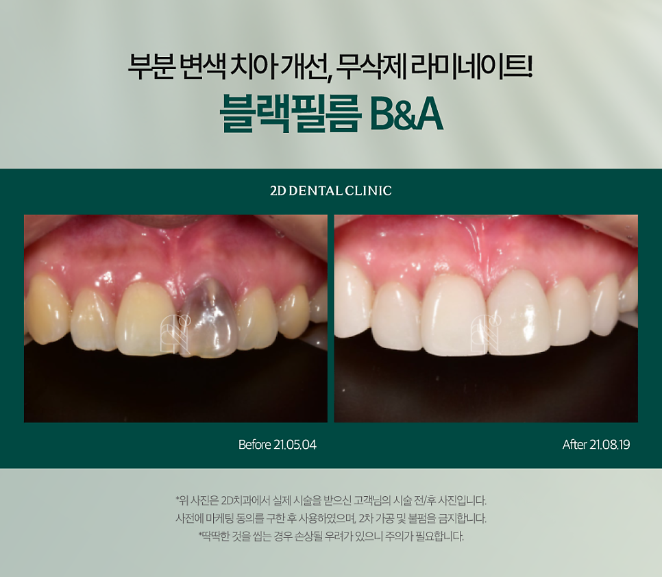 대전무삭제라미네이트 치아부분변색 전후 차이와 비용까지! 관련 이미지 6