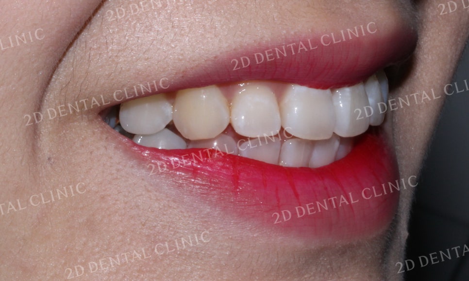 [앞니교정] 부정교합 교정, 앞니교정으로 부정교합 교정하는 방법! by. 투디치과(2D치과) 관련 이미지 12