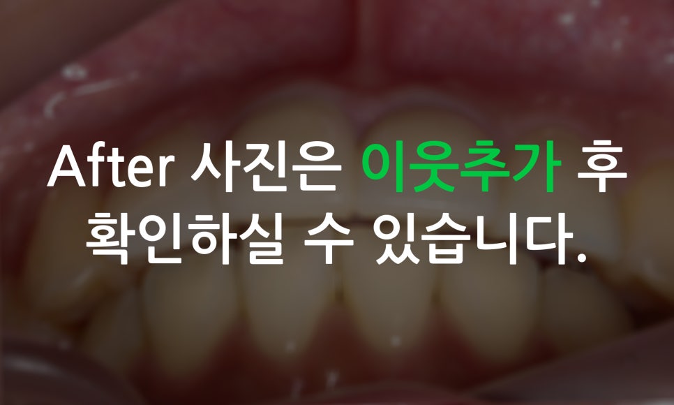 토끼앞니교정, PFM크라운 재보철을 동시에 치료하는 방법? 관련 이미지 14