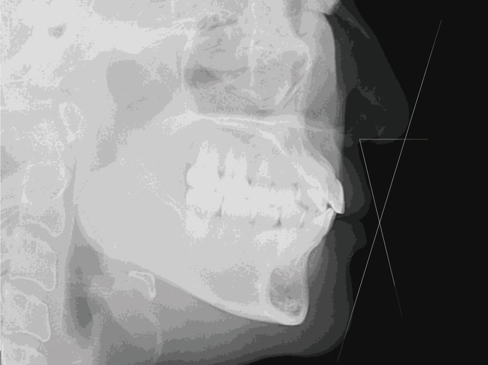 2D치과(투디치과) 교정일기ㅣ앞니덧니,반대교합 치아교정 완료!(ft.투디교정 전체교정) 관련 이미지 7